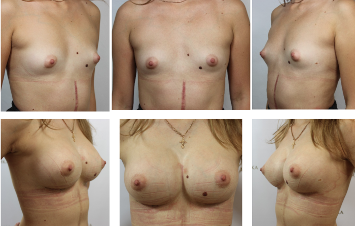 Forms of naked female breast