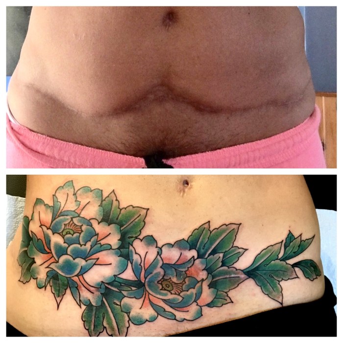 Shraming from Caesarean