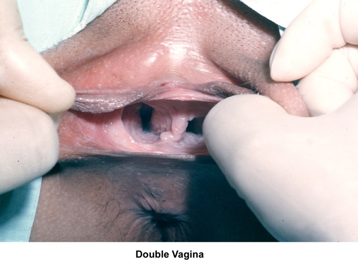 The vagina of pregnant women is large