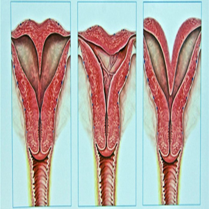 Double -haired saddle uterus