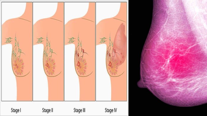 Breast Cancer Diagnosis