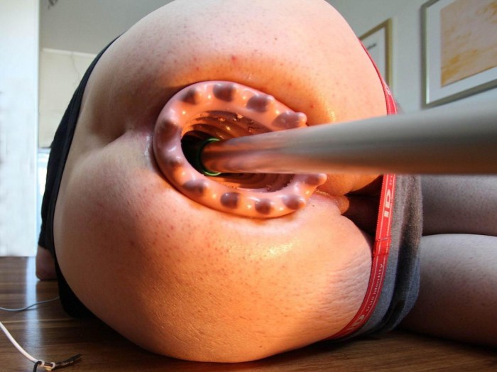 Unusual objects in the anus