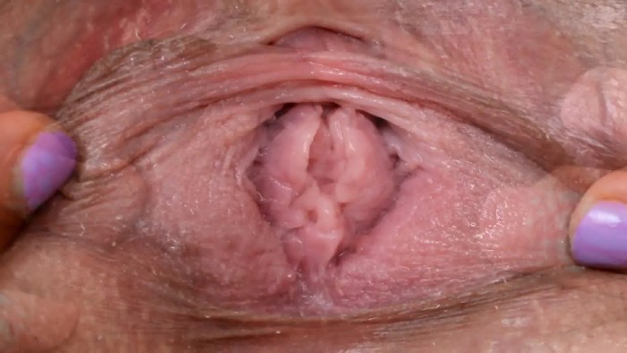 Genital warts in the vagina