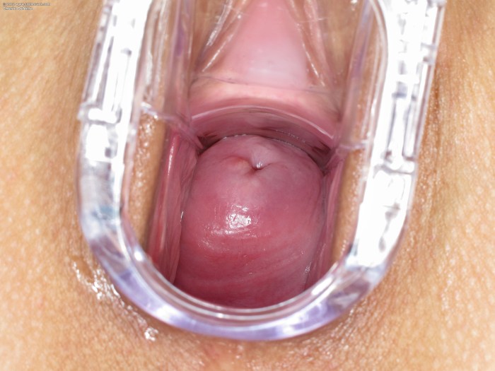 The walls of the vagina from the inside