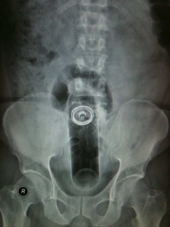 Beer can in the vagina