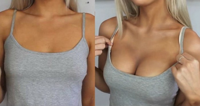 Increased breasts