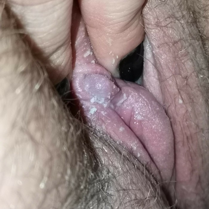 Dirty vagina with thrush