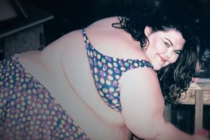 Morbid obesity naked