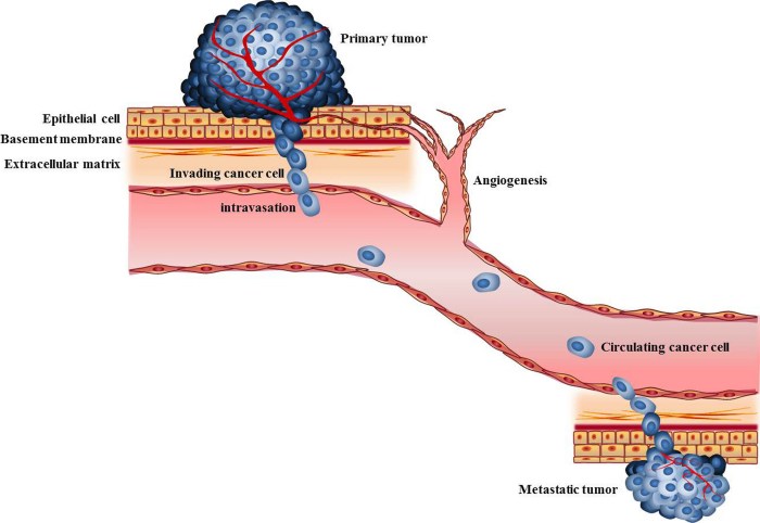 Metastasis of cancer tumors