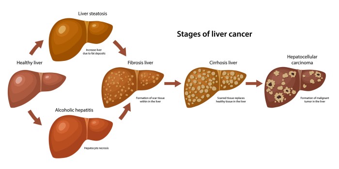 Figo Staging Ovarian Cancer