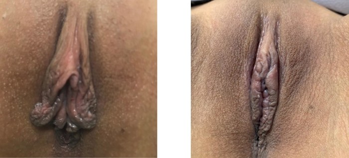 Clitoral Hood Reduction result