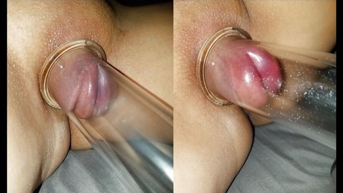 Penis after vacuum pump