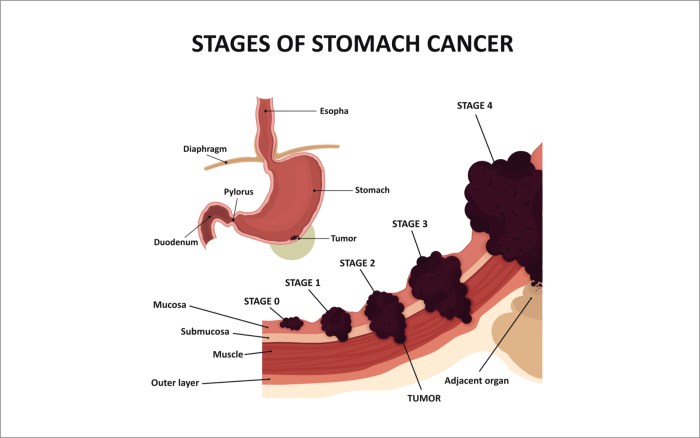 What can be the PSA in Prostate Disease?