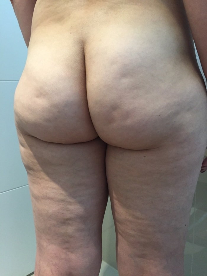 Cellulite priests of women