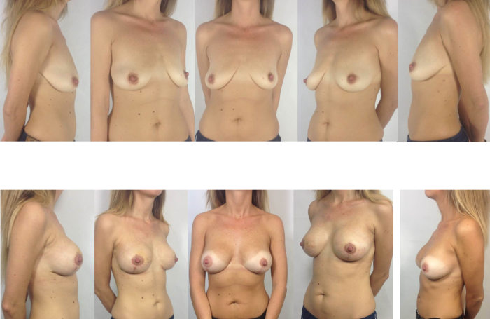 Forms of naked female breast