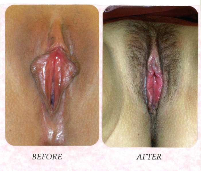 Plastic surgery of vagina