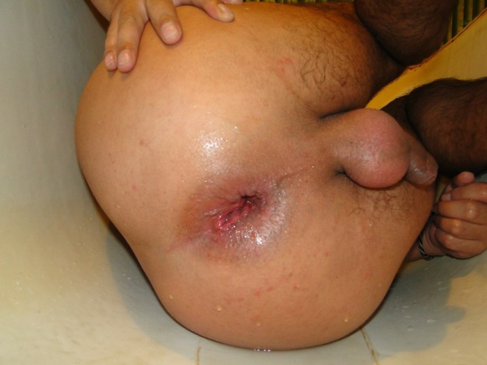 Blagless male anus